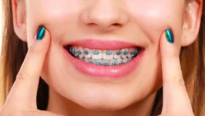 Mooresville Braces