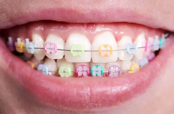 close up shot of a person's teeth with colorful braces rubber band