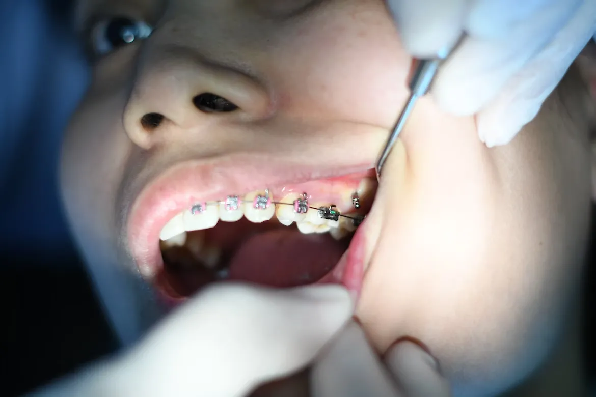 a dentist showing how the metal braces look like on teeth