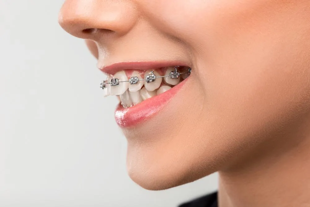 close-up shot of a woman's teeth with braces