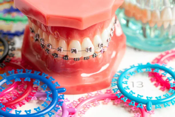 a dental model with full braces surrounded with rubber bands in different colors
