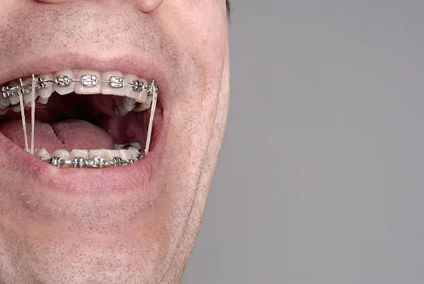 a close-up shot of a person's mouth with braces and elastics