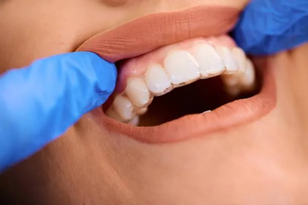 close up of woman getting dental aligner on her teeth at dentist's